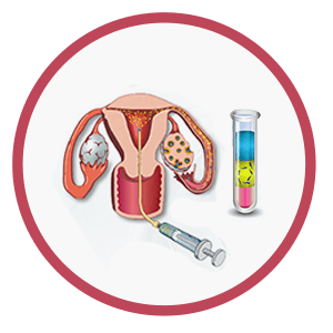 Intrauterine-insemination-IUI