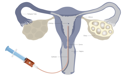 Embryo Transfer Procedures
