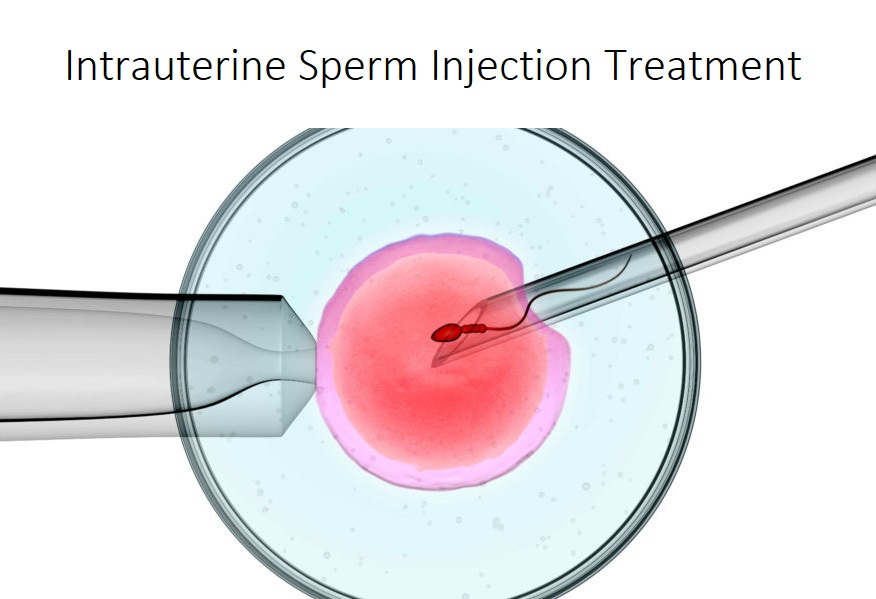 Intrauterine Sperm Injection
