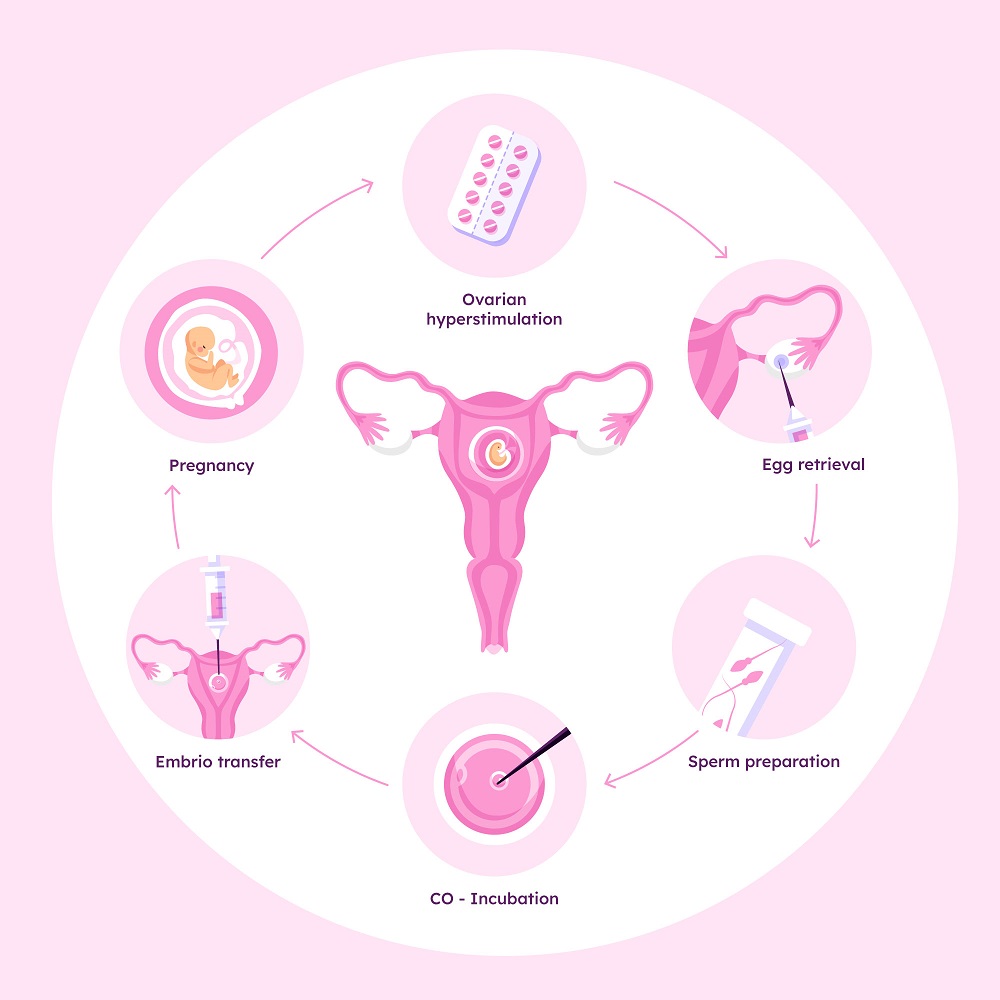 IVF Process and Preparation